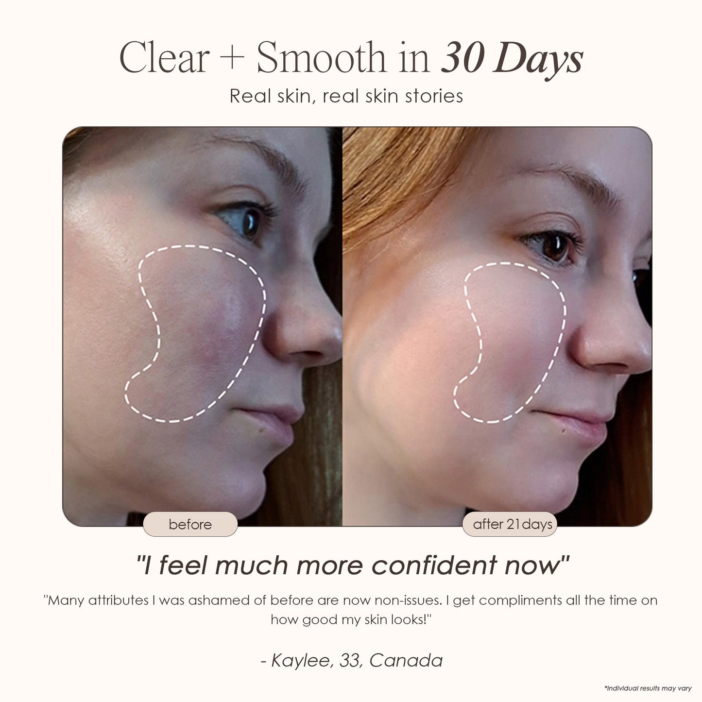 Lasentis™ High Frequency Therapy Kit: The Dermatologist's Secret for Acne & Wrinkles