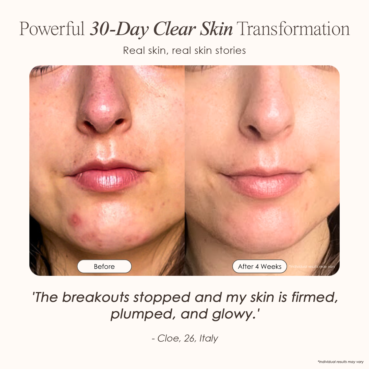 Lasentis™ High Frequency Therapy Kit: The Dermatologist's Secret for Acne & Wrinkles